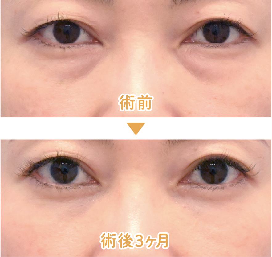【40代前半 女性】目の下の切らないクマ・たるみ取り