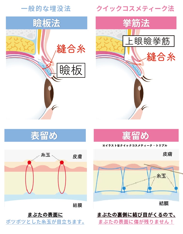 糸が取れづらく、自然な仕上がりで腫れにくい埋没法