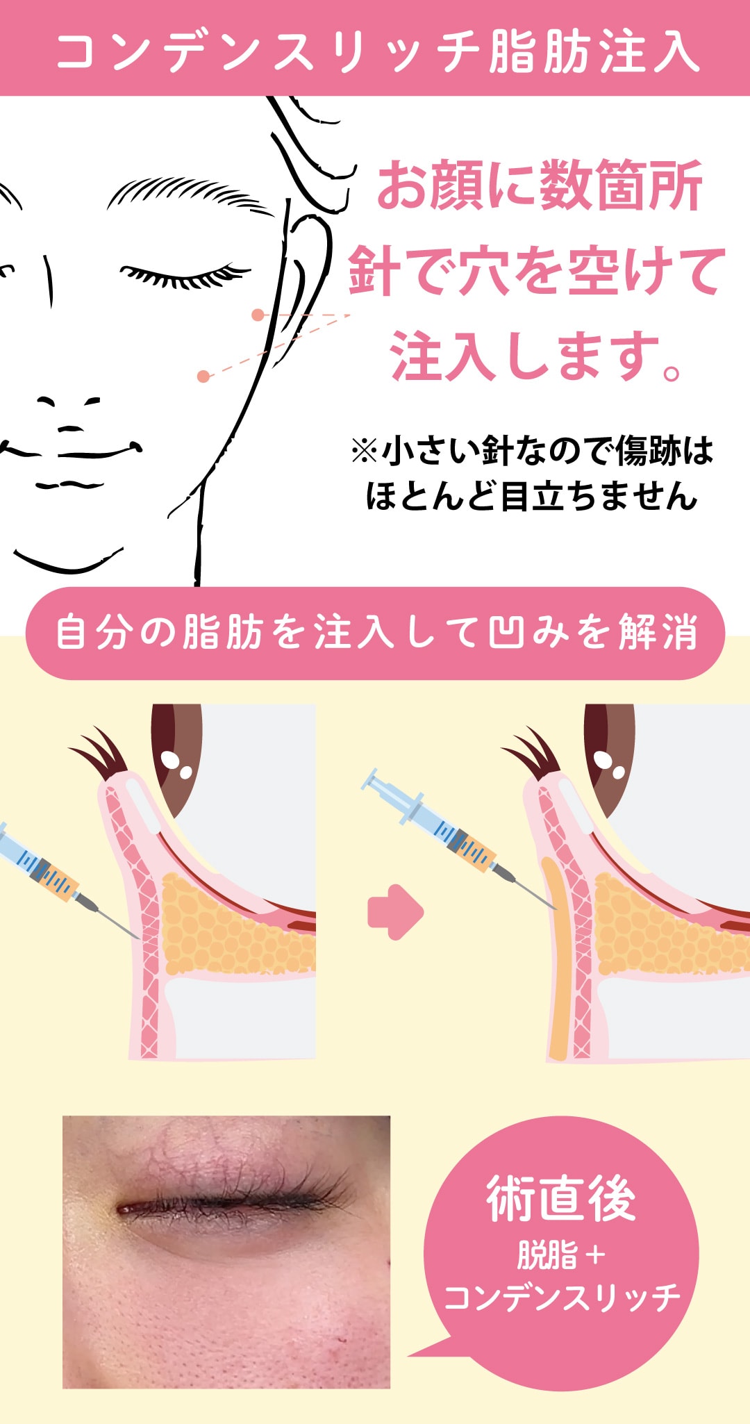 脂肪注入：コンデンスリッチ【凹み改善】