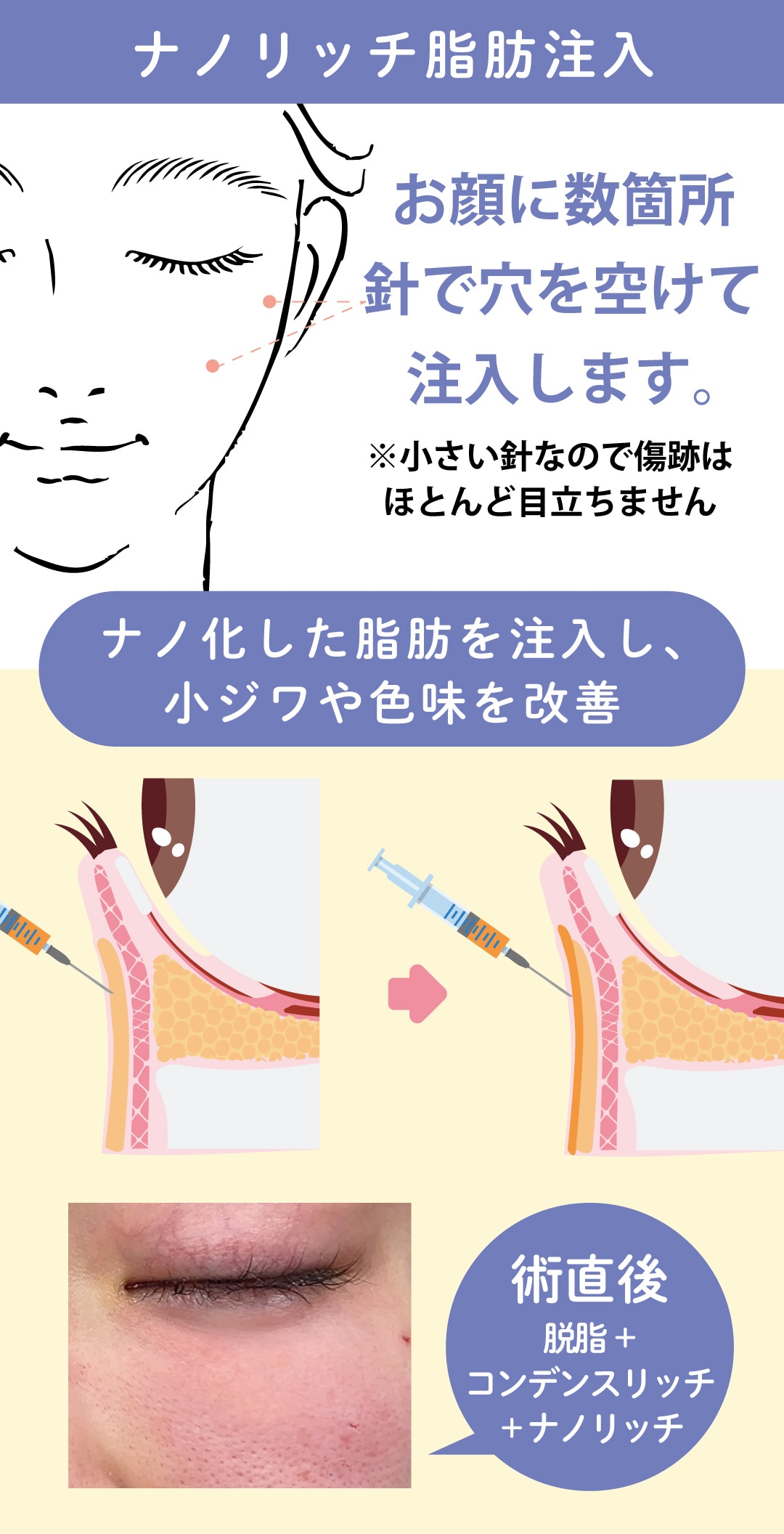 脂肪注入：脂肪注入注射ナノリッチ【色味・小ジワ・窪み改善】
