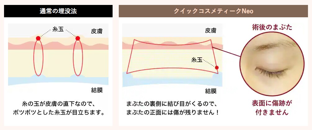 限られた医師のみ執刀可能な二重埋没法【クイックコスメティーク】ができる！