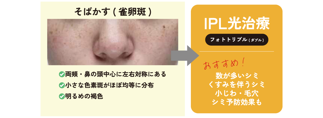 そばかす