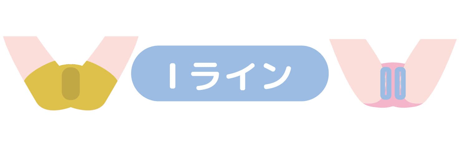 Iライン