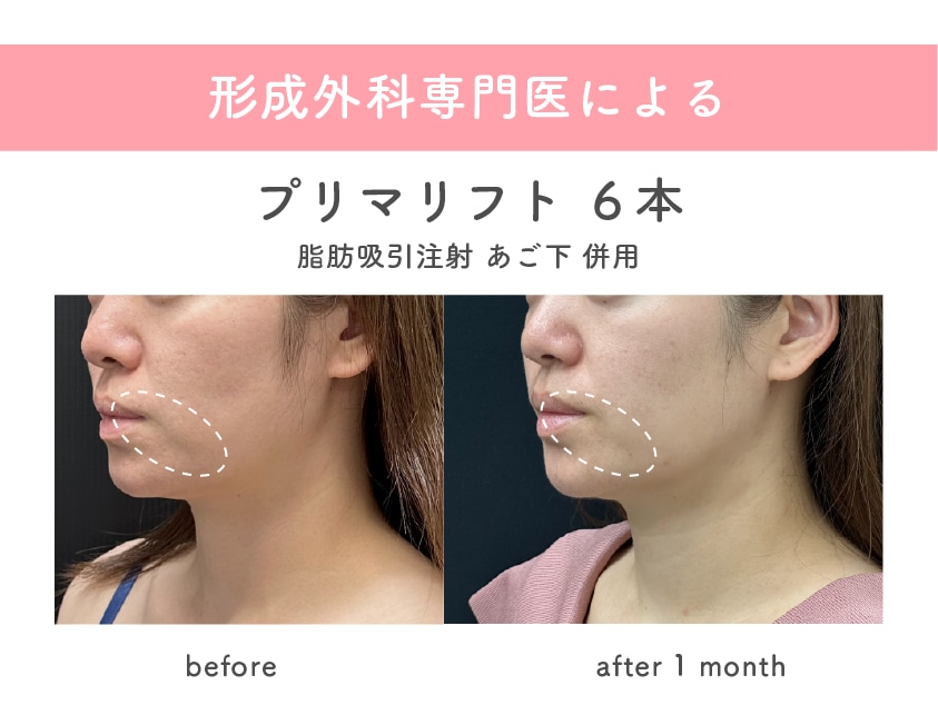 森🌳院長は糸リフトと脂肪吸引の症例件数が多数！