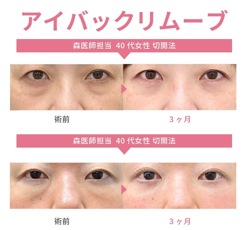 アイバックリムーブ法（執刀数No.2獲得済み👑）