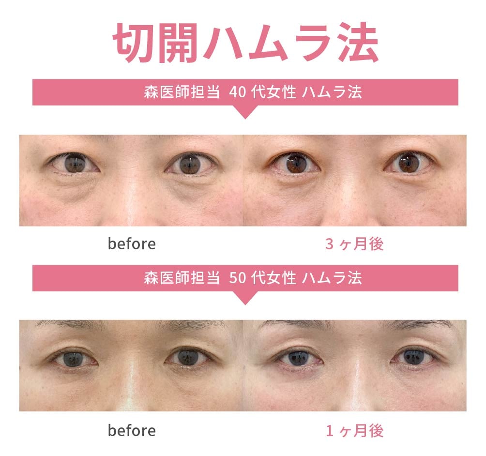 切開ハムラ（執刀数No.2獲得済み）