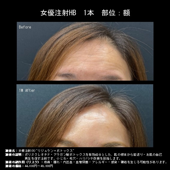 女優注射HB