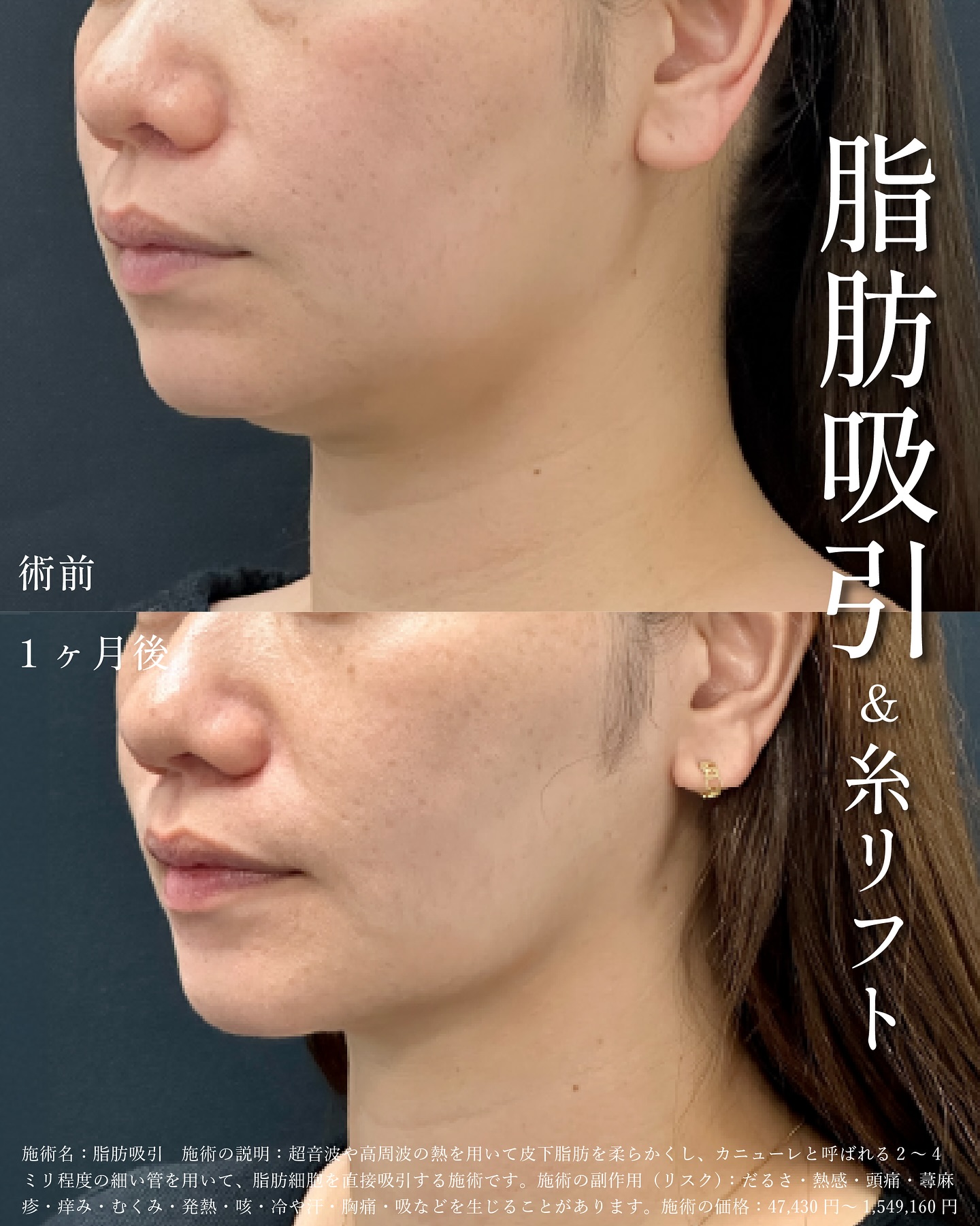 体表面の専門家＼形成専門医が担当する／顔の脂肪吸引