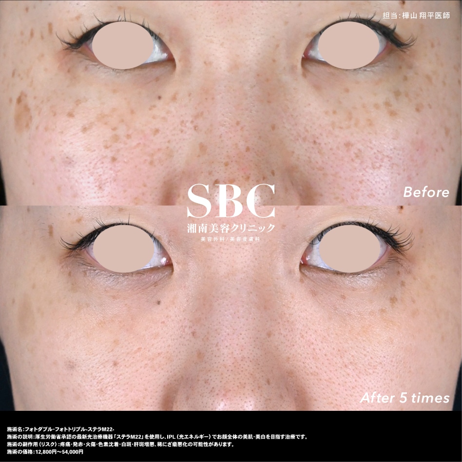 「シミ」が主な悩みならフォトフェイシャル