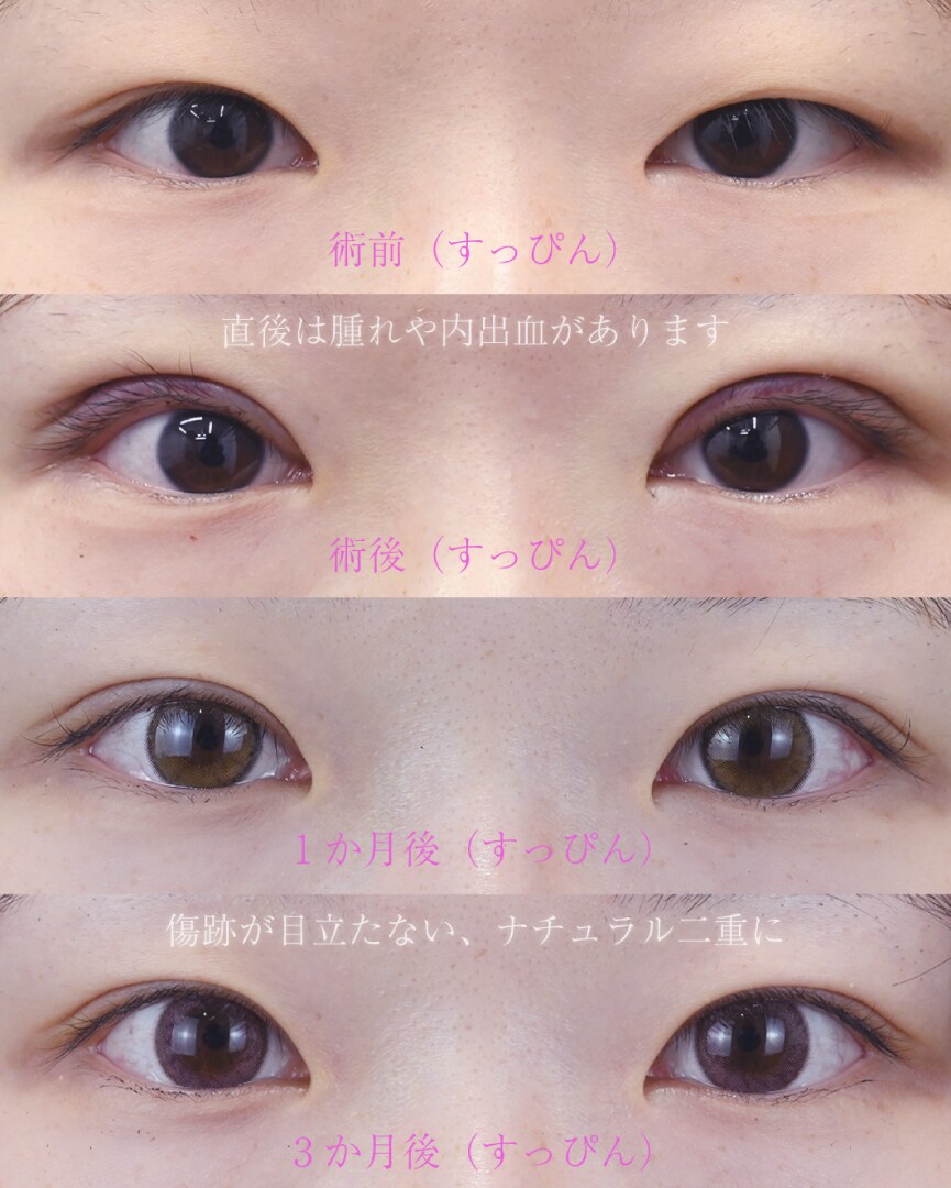 たるみ取り併用全切開法二重術