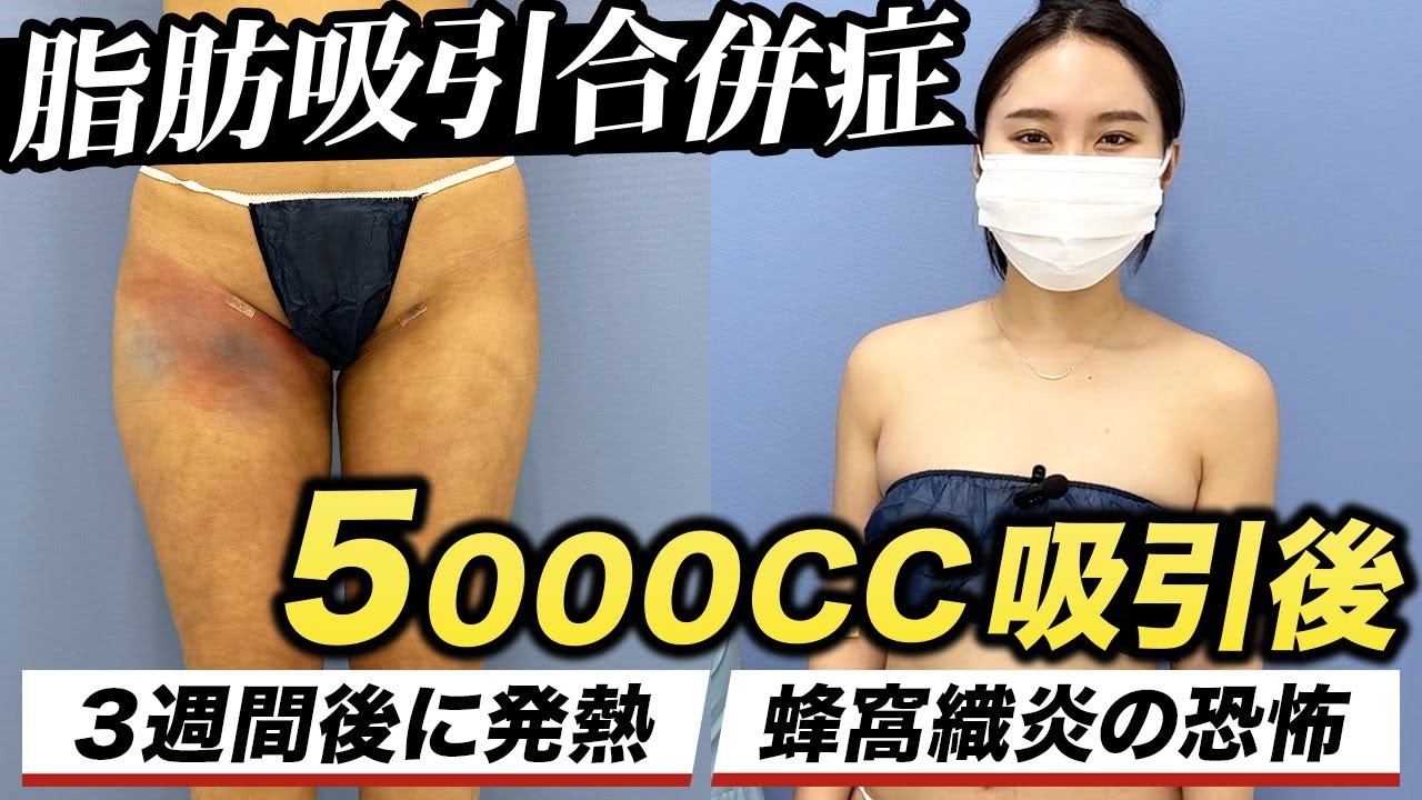 脂肪吸引後の蜂窩織炎に注意！発熱などの症状や対処法も解説！
