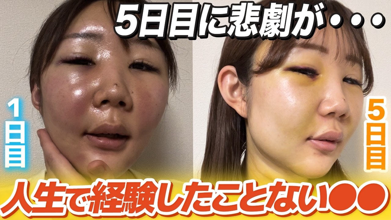 顔の脂肪吸引ダウンタイム14日間レポートをお届け！気になる経過は？