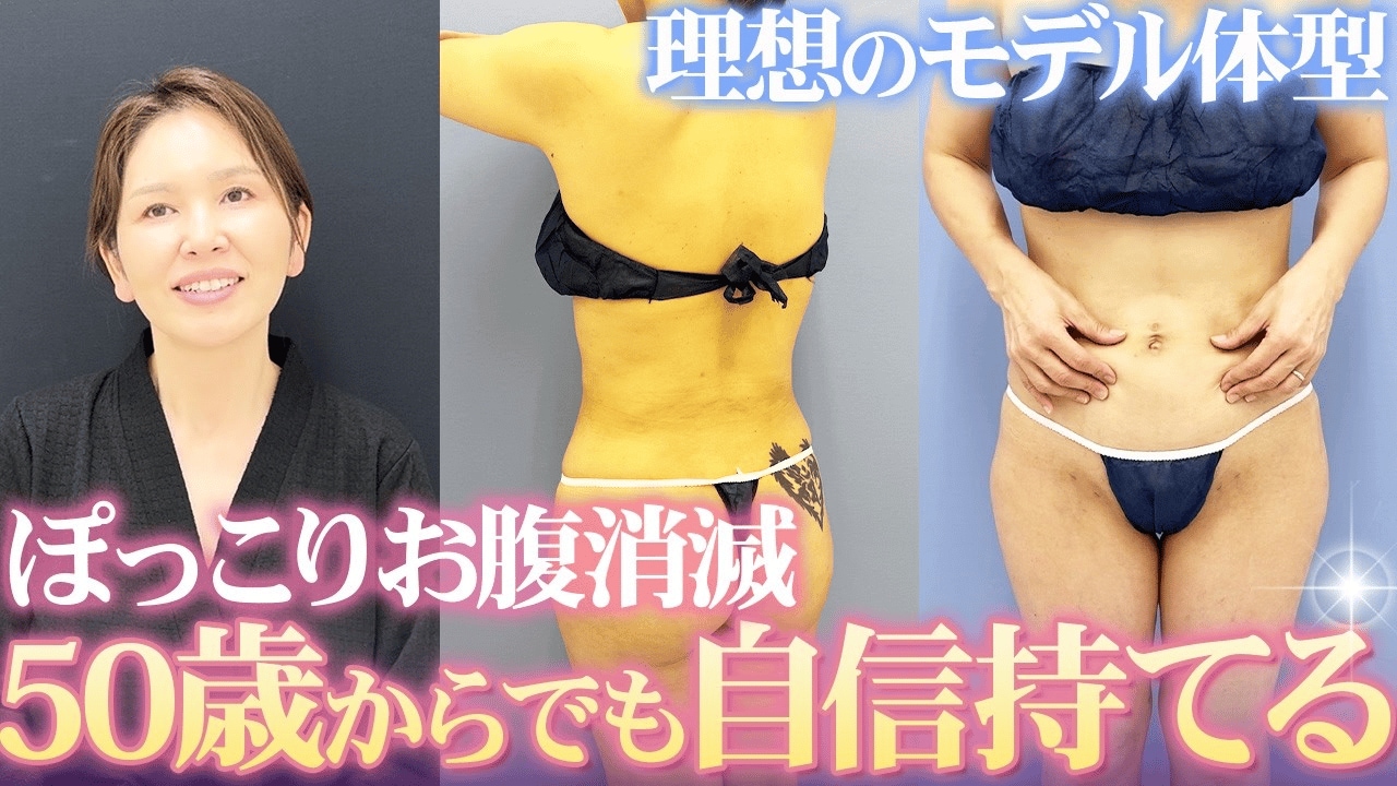 お腹の脂肪吸引ダウンタイム1ヶ月目に直撃！50歳女性がどう変わった？