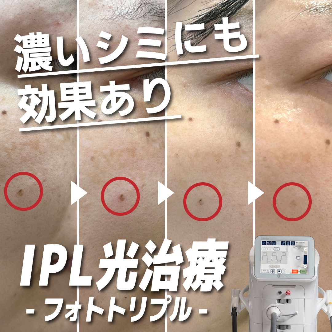 【フォトトリプル】効果ない？本当にシミは消える？スタッフが検証！