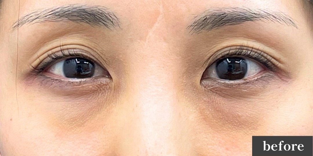 {目の下の切らないクマたるみとり} {年代} {女性} の術前の症例写真