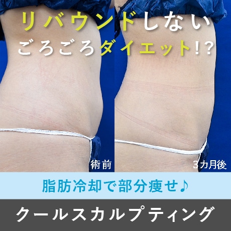 【福岡・医療ダイエット】脂肪冷却クルスカで部分痩せ!効果なしって本当?(湘南美容クリニック博多院・クールスカルプティングダブル)二の腕・お腹・太ももなど 通常価格より安いモニターも募集中!