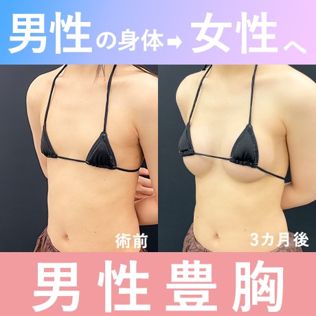 【男性豊胸】トランスジェンダー豊胸・MtF豊胸|おすすめの施術は?症例写真も公開!男性豊胸も募集中!