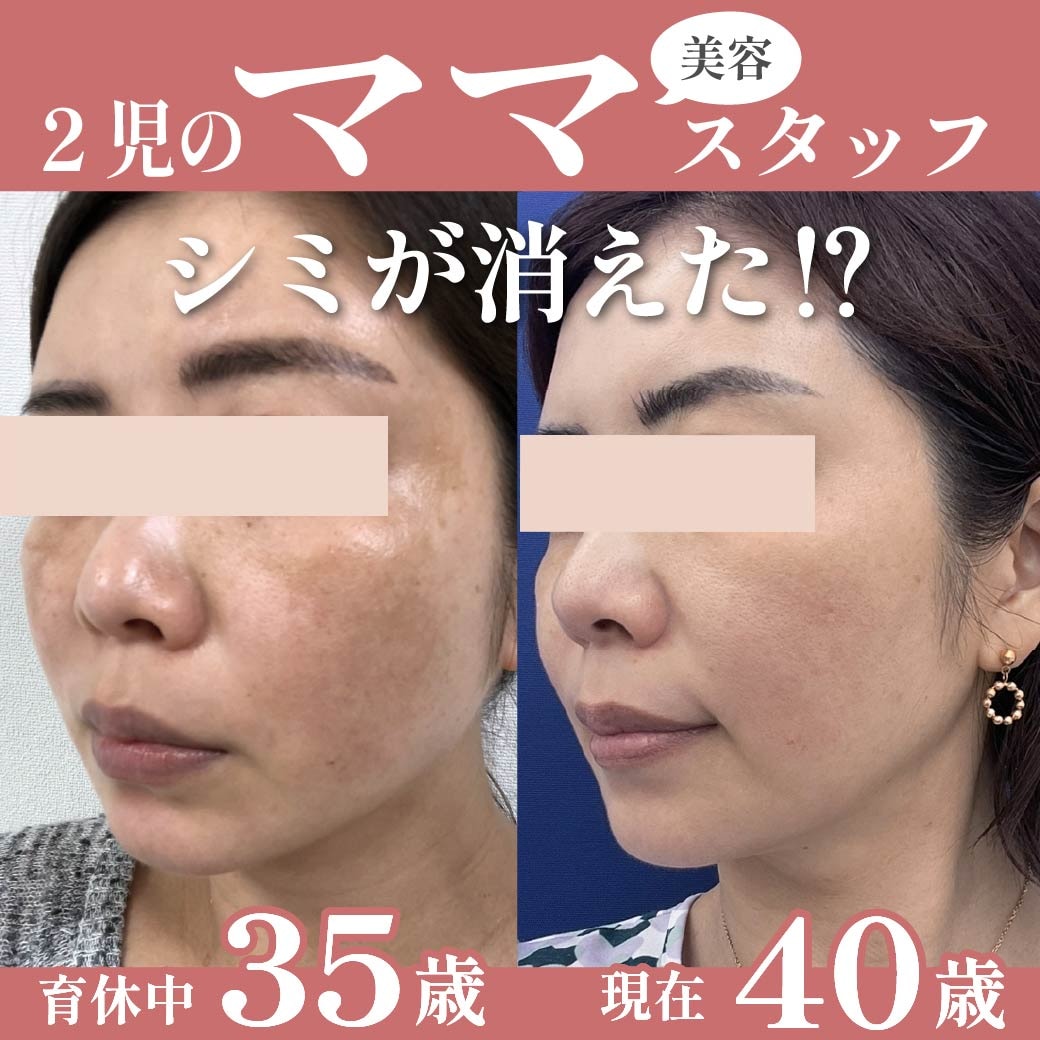 【シミにお悩みの方必見!】現役ママスタッフが実践!美容内服×IPLレーザー×ピコトーニングで叶える透き通る素肌