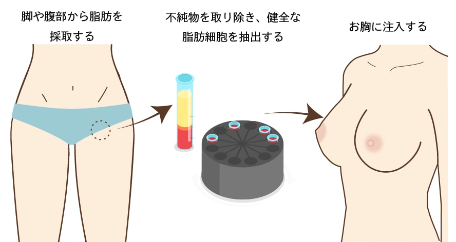 脂肪注入豊胸とは？