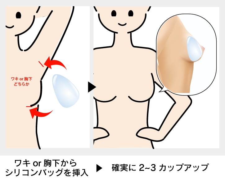 シリコンバッグ豊胸：確実なサイズアップと維持力