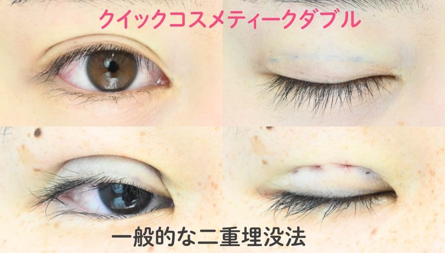 他の二重埋没法とも比較してみた！