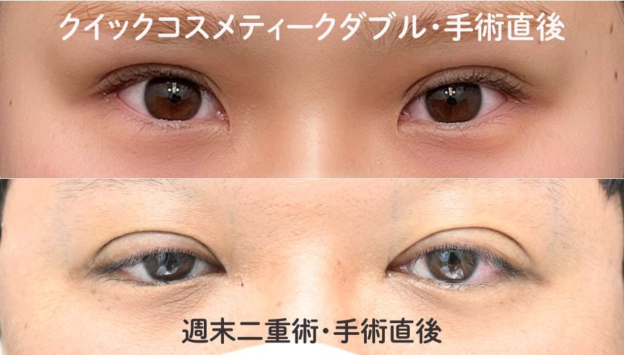 術後の腫れはひとめでわかる！