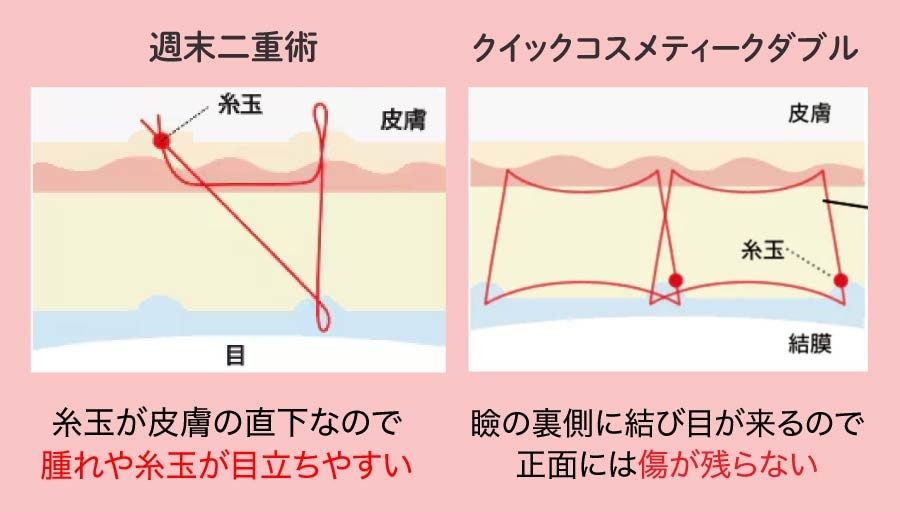 腫れの違いは術式にある