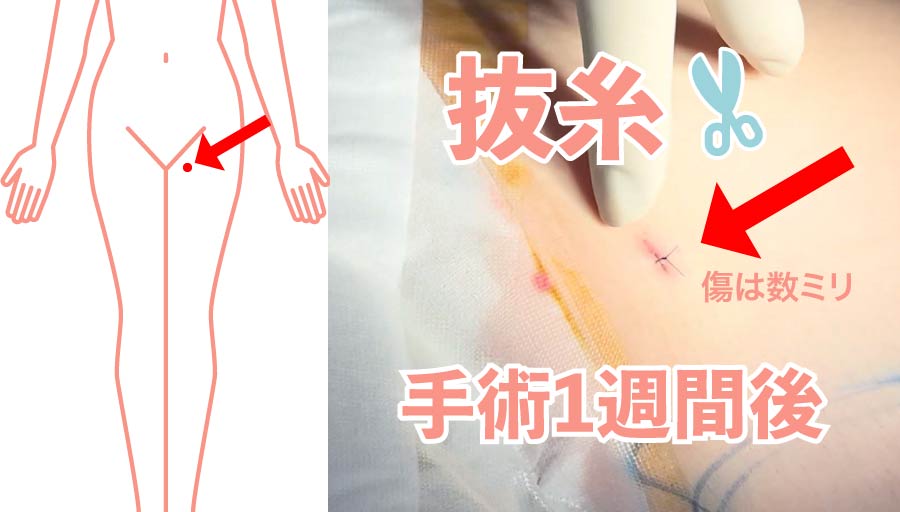 抜糸