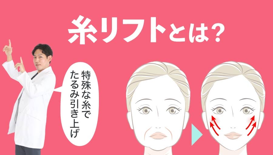 糸リフトとは