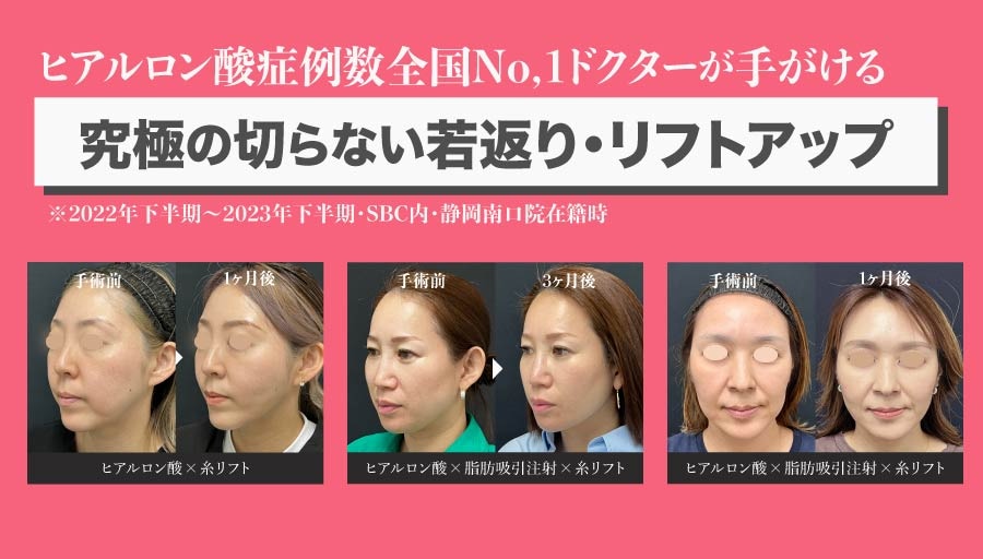 トータルバランスを追求した究極のリフトアップ