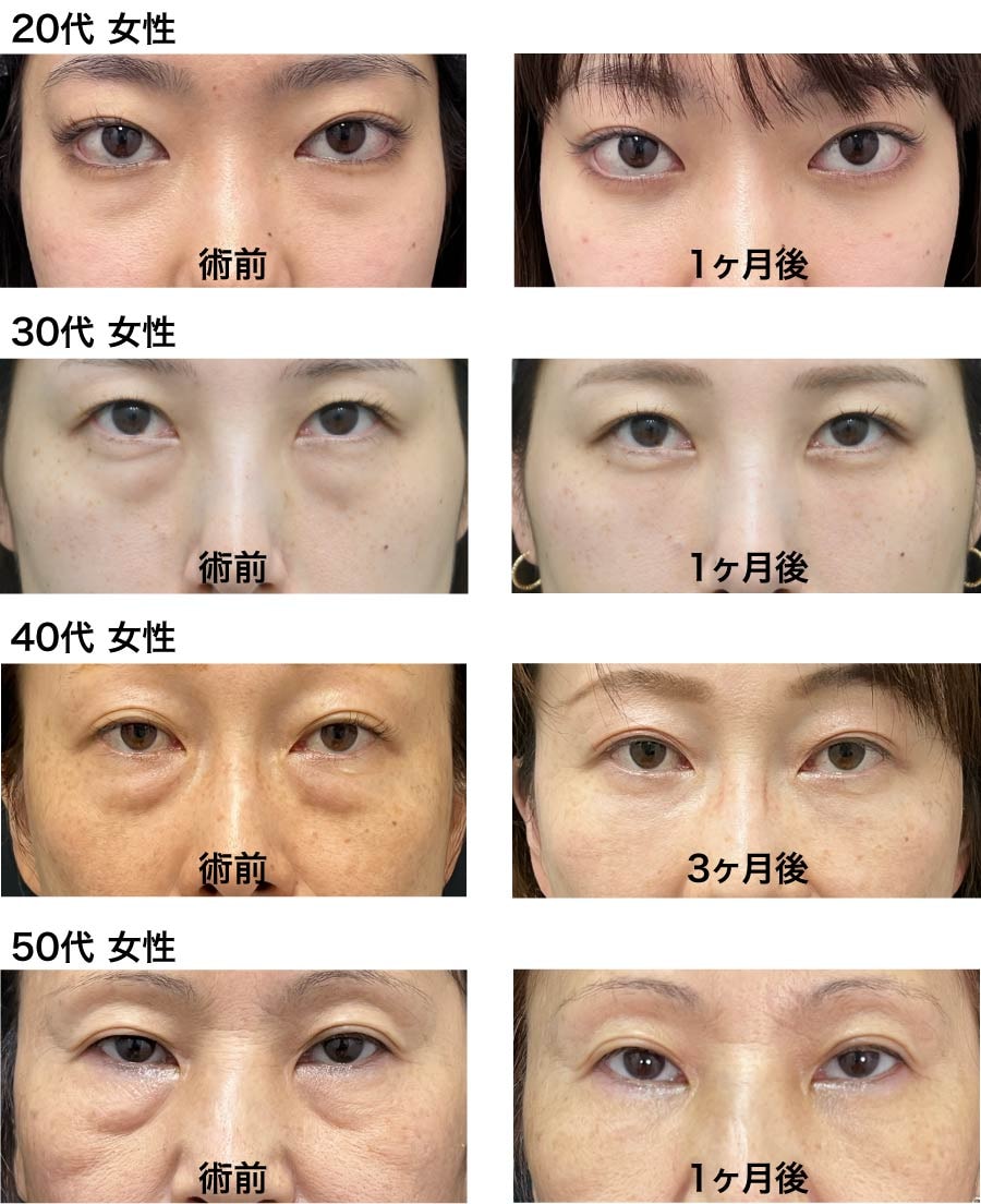 クマ取り（脱脂）＋脂肪注入症例<br />
圧倒的な自然さと確かな技術力で全国から指名殺到中！