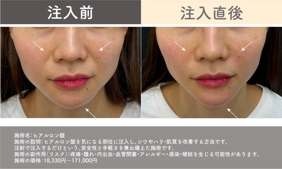 ほうれい線 あご