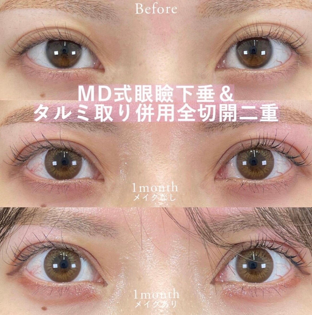 眠そうな目をぱっちりさせたい