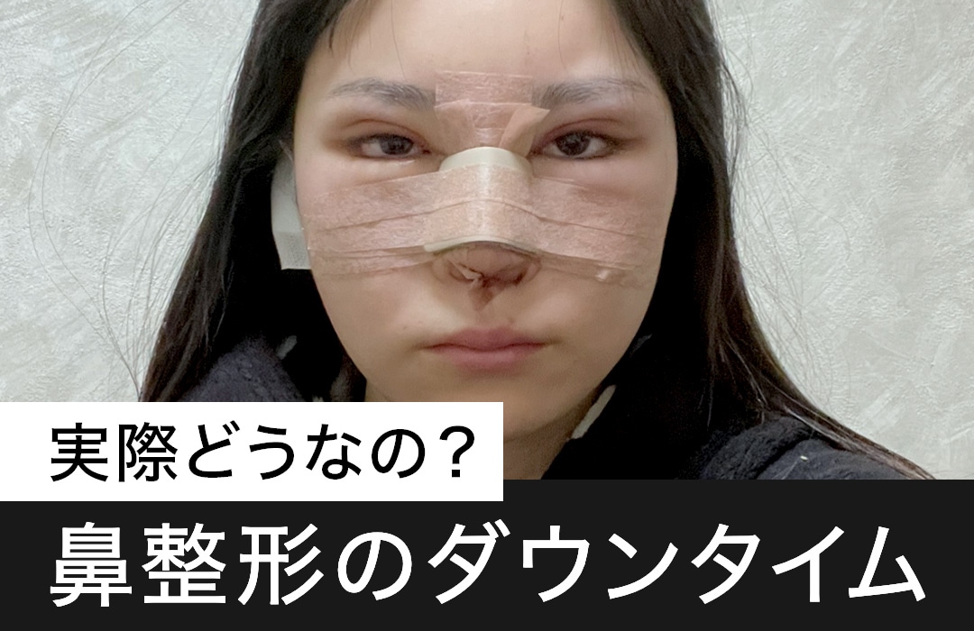 【鼻整形のダウンタム】期間は？腫れる？バレる？湘南美容クリニック原宿院(東京・渋谷)