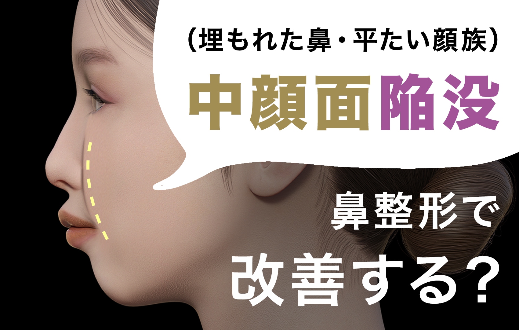 【中顔面陥没】を治したい…貴族手術不要!鼻整形をすると治る!?湘南美容クリニック原宿院(東京・渋谷)
