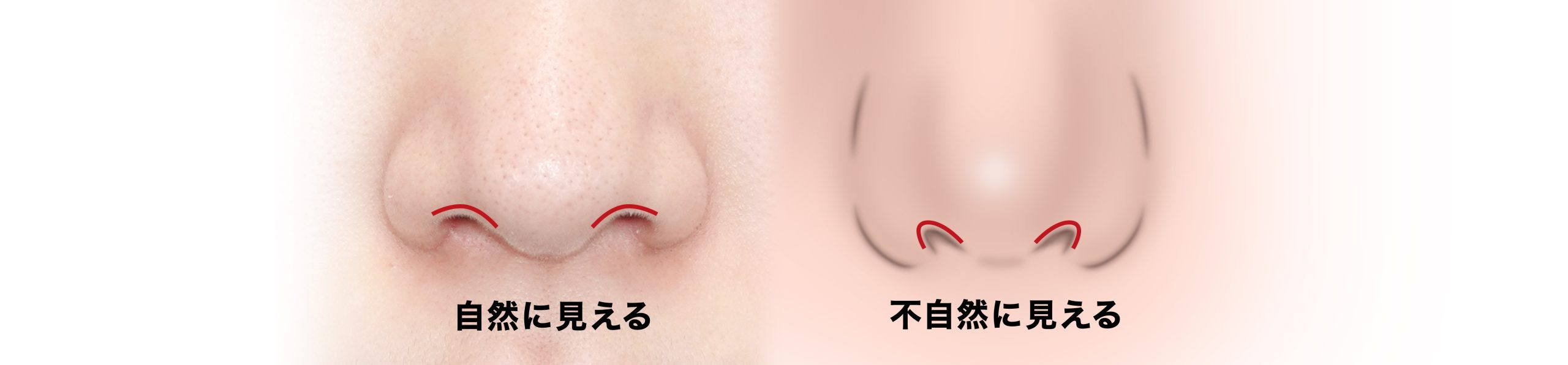 鼻孔縁