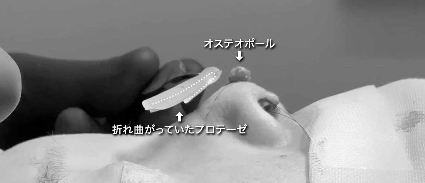 プロテーゼ＋オステオポール