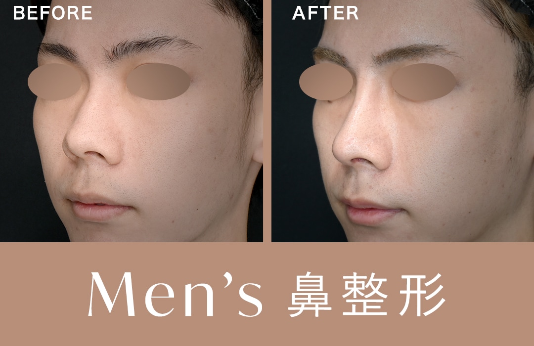 【鼻整形は男性もおすすめ】「顔に似合う自然な鼻」費用・症例についてご紹介！【SBC原宿院(東京・渋谷)】