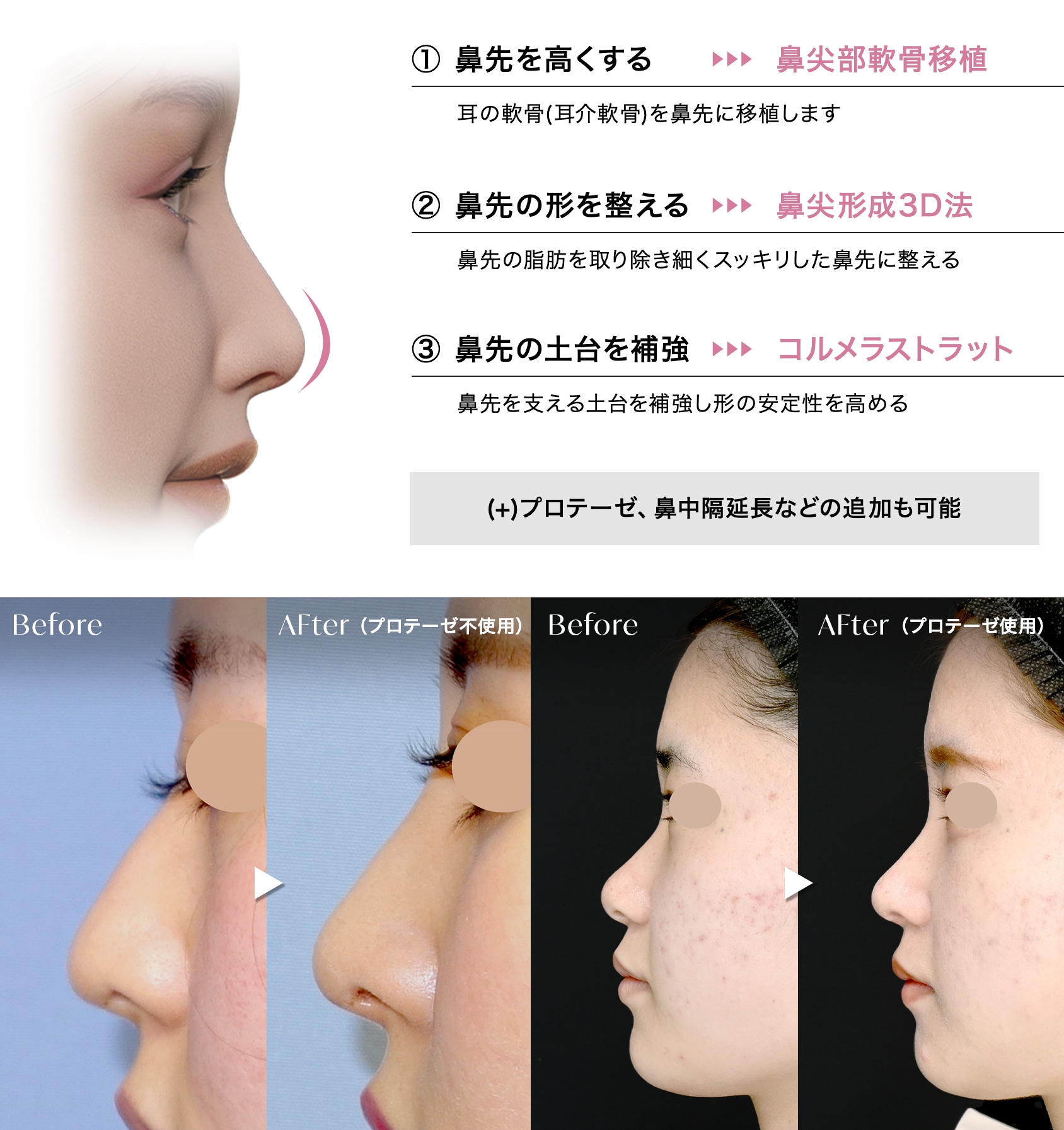 鼻先すっきりセット