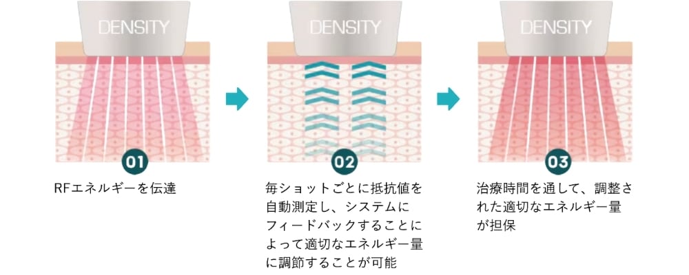 理由②：肌状態を確認し、均一なエネルギーを照射