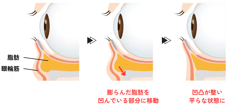 ハムラ法って何？