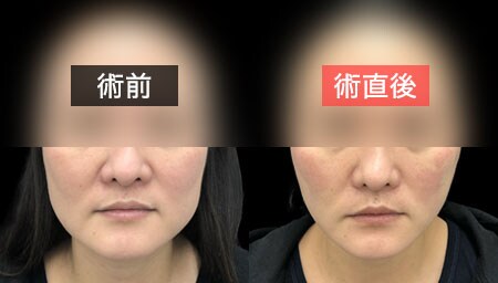 中顔面およびフェイスラインのたるみが気になる方