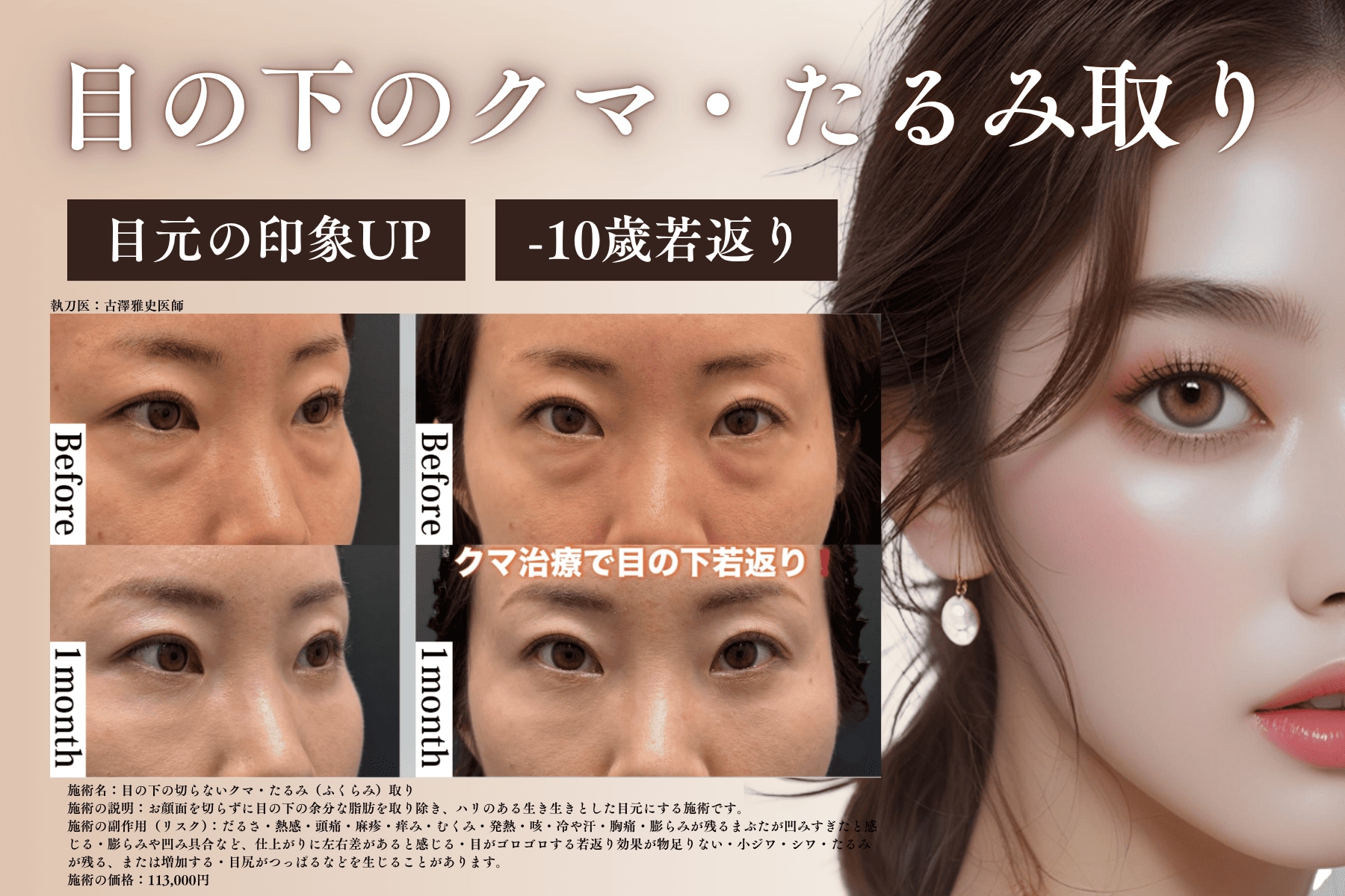 目の下の切らないクマ・たるみ取り