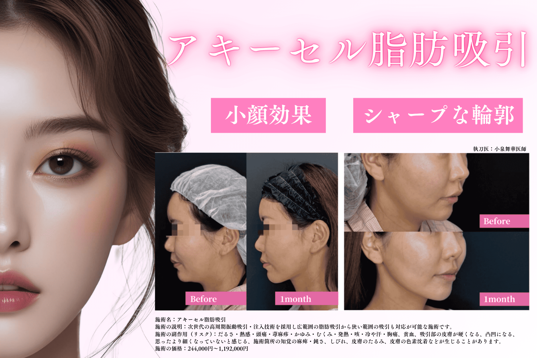 アキーセル脂肪吸引