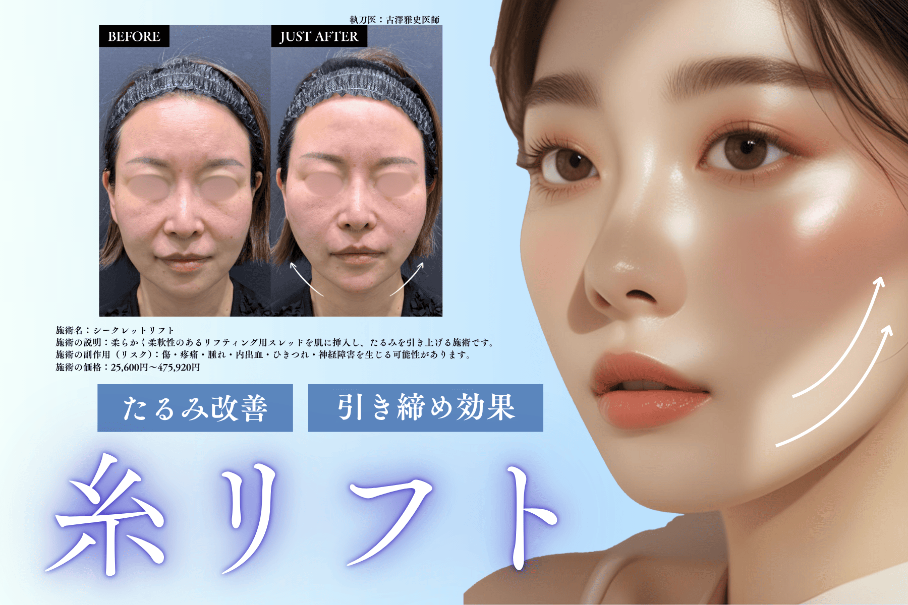 糸リフト