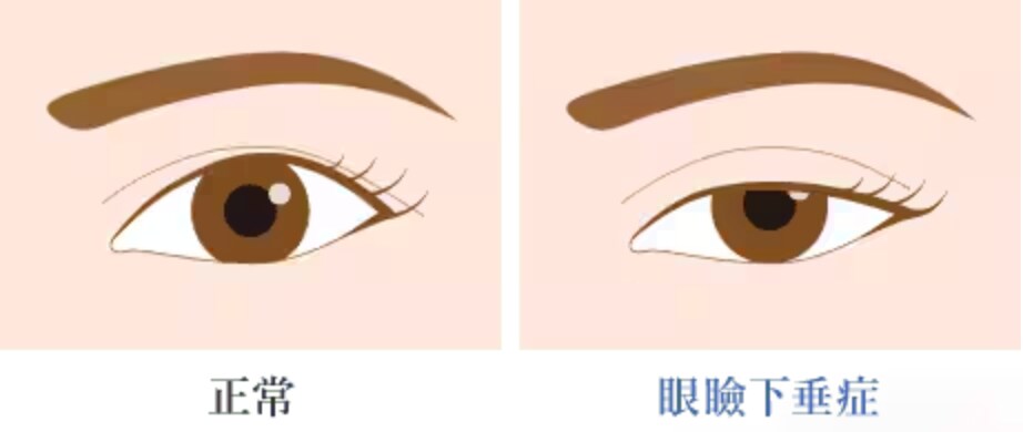 眼瞼下垂とは