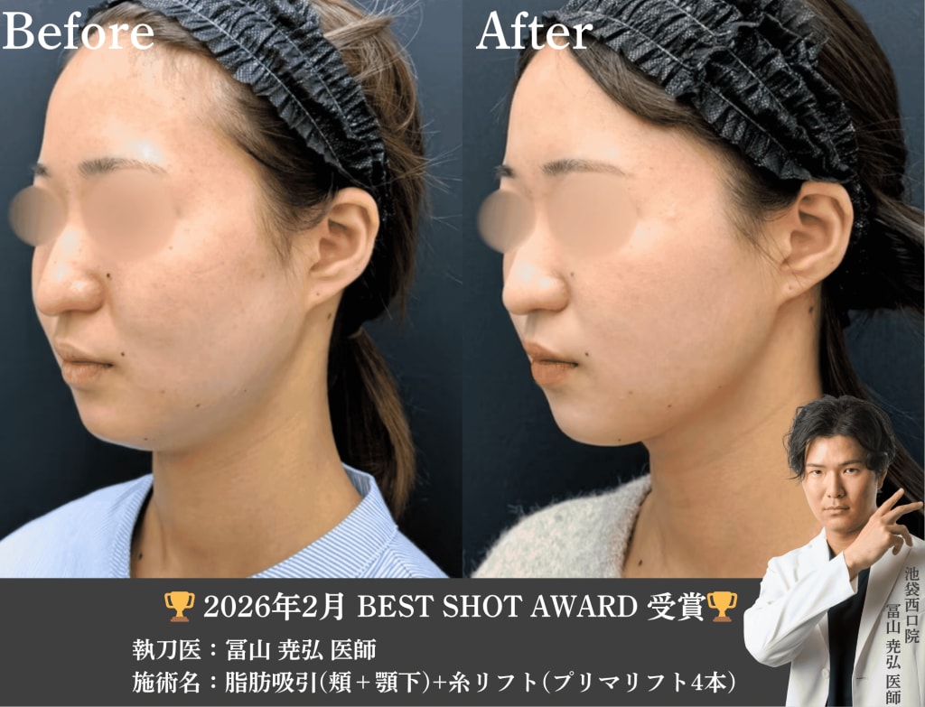 池袋西口院 冨山医師 SBCベストショット賞受賞 糸リフト 脂肪吸引 症例写真 小顔