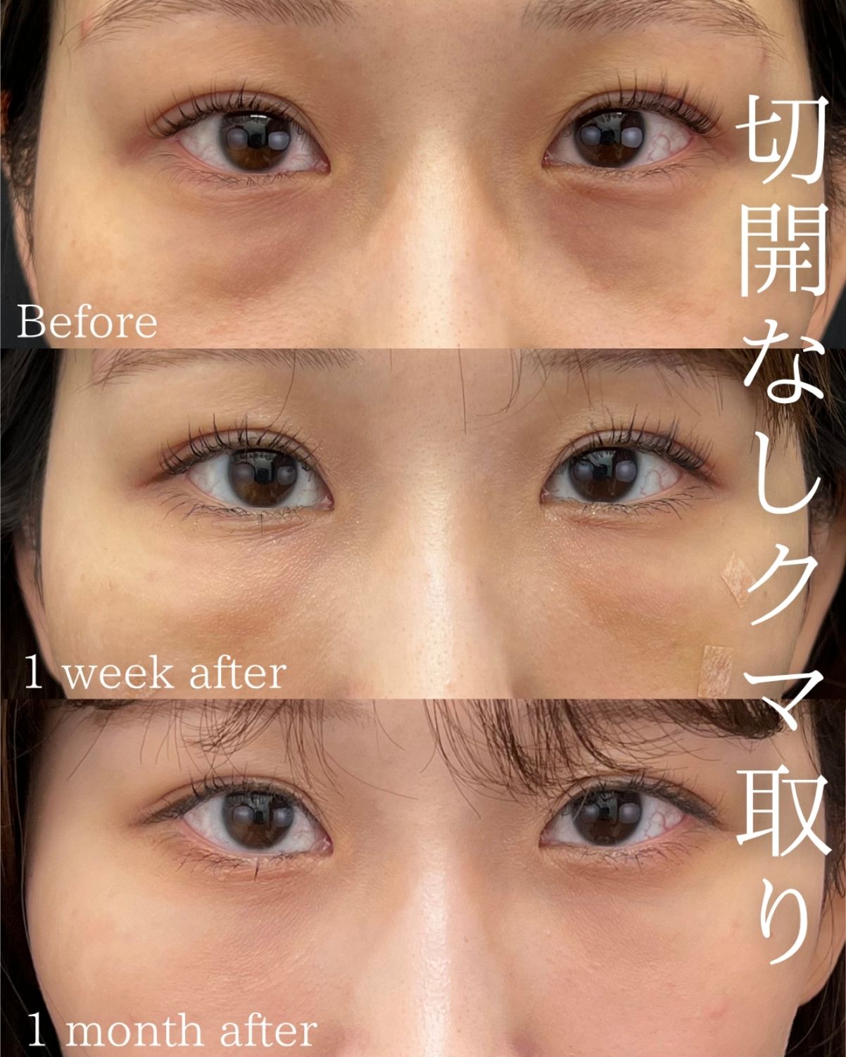 <ul><br />
【目の下の切らないクマ取り・たるみ（ふくらみ）取り】<br />
【コンデンスリッチフェイス（脂肪注入）】<br />
【ナノリッチ（脂肪注入）】<br />
<ul/>