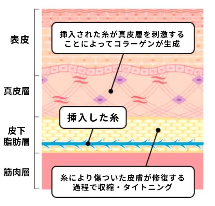 糸リフト