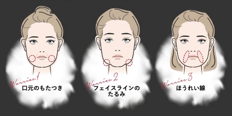 糸リフト